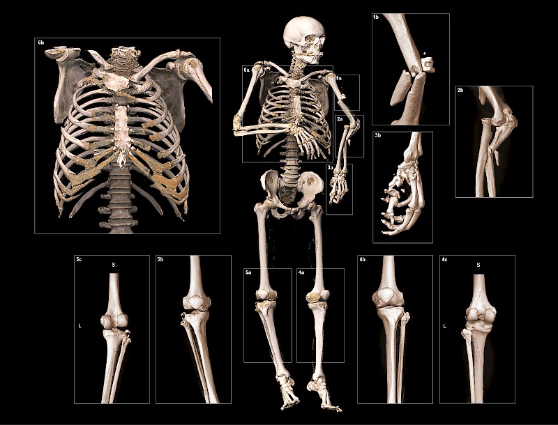 Virtopsy ist ein modernes bildgebendes Verfahren zur Darstellung von gerichtsmedizinischen Befunden, die der Rechtsprechung dienen. Dabei werden Computertomographiedaten durch visuelle Rechenvorgänge in der Software so aufbereitet, dass der Eindruck einer „echten“ anatomischen Darstellung entsteht. Die Arbeit untersucht, wie die erstellten Bilder durch Eingriffe in die Voreinstellungen der Visualierungs-Software transparenter, verständlicher und wissenschaftlich korrekter gemacht werden können. Als Resultat des Projekts entstanden eine Reihe von gestalterischen Software-Einstellungs-kombinationen. Das Anwenden dieser verbesserten vordefinierten Einstellungen unterstützt die Rechtsmediziner effizient im beruflichen Alltag und verbessert die Lesbarkeit und Interpretation der vermittelten Bilder entscheidend.