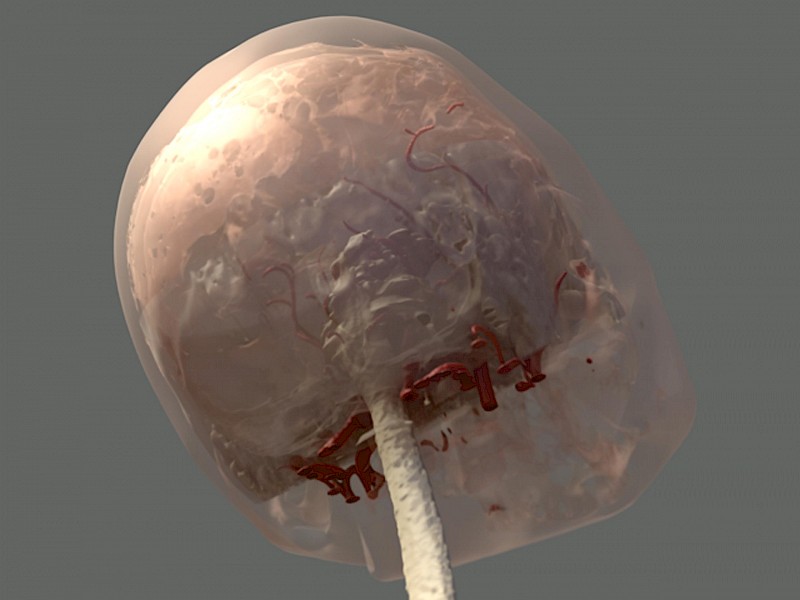 Gestaltete MRT- & CT-Daten (Hirnstamm, Arterien, Knochen und Schädelumriss), OP-Situs.