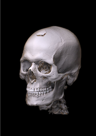 Tiefenvermittlung durch Schattierung der anatomischen Objektform. Darstellung Volumenrendering. Ansicht von links vorne. Im Rahmen dieser Arbeit verbesserte Tiefenvermittlung durch ergänzte räumliche Schattierung.