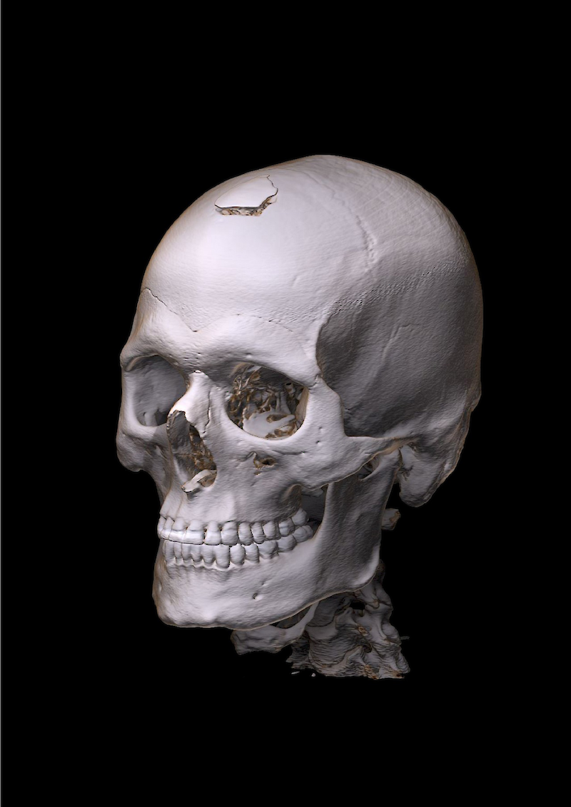 Tiefenvermittlung durch Schattierung der anatomischen Objektform. Darstellung Volumenrendering. Ansicht von links vorne. Im Rahmen dieser Arbeit verbesserte Tiefenvermittlung durch ergänzte räumliche Schattierung.