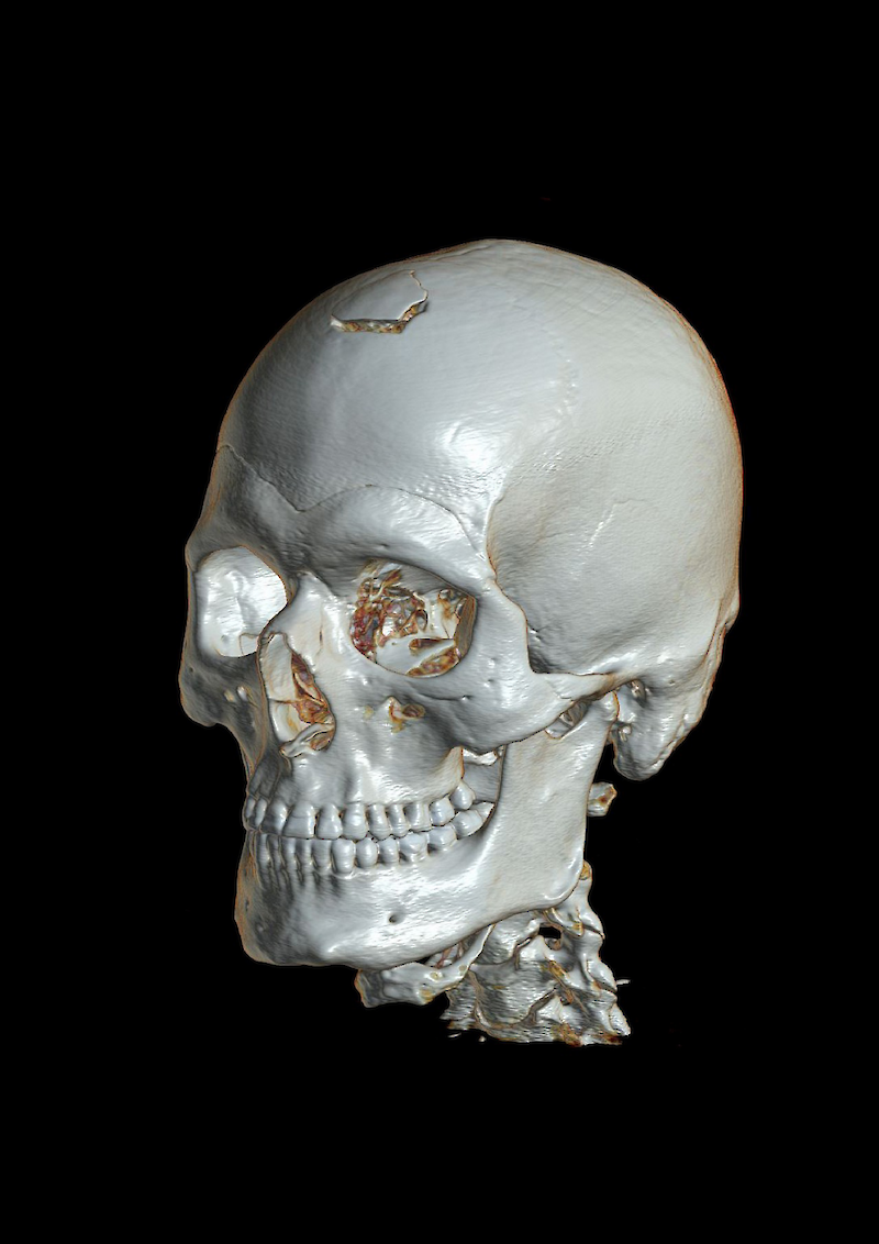 Die Überlagerung und Überschneidung von dreidimensionalen Strukturen vermittelt die räumliche Form oft ungenügend. Das Ergänzen von tiefenwirkenden Schattierungen sowie das Anaglyphenverfahren (Rot-Grün- bzw. Magenta-Cyan-Brille) stellen Möglichkeiten dar, den Eindruck von Räumlichkeit zu vermitteln. 3D-Rekonstruktion des Schädels und Projektils mit syngo.via® (Standard Software-Preset). Darstellung Volumenrendering. Ansicht von links vorne.