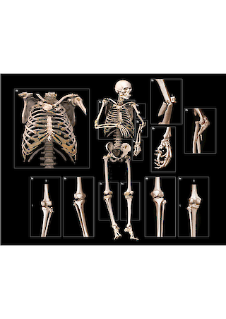 3D-Rekonstruktion des Skeletts als Kontext und der Befunden als Detail mit syngo.via® Darstellung Volumenrendering. Die bei Licht betrachtete menschliche Anatomie bietet nur wenige Farbkontraste. Diese sollen bei einer technisch-visueller Datenrekonstruktion entsprechende Farbkonventionen naturalistisch anmuten angewendet werden, um die Wiedererkennung zu ermöglichen. Mit der Methode des Ausschnitts und der Vergrösserung lassen sich Details bzw. Vergrösserungen besser in ihrem anatomischen Zusammenhang verstehen.