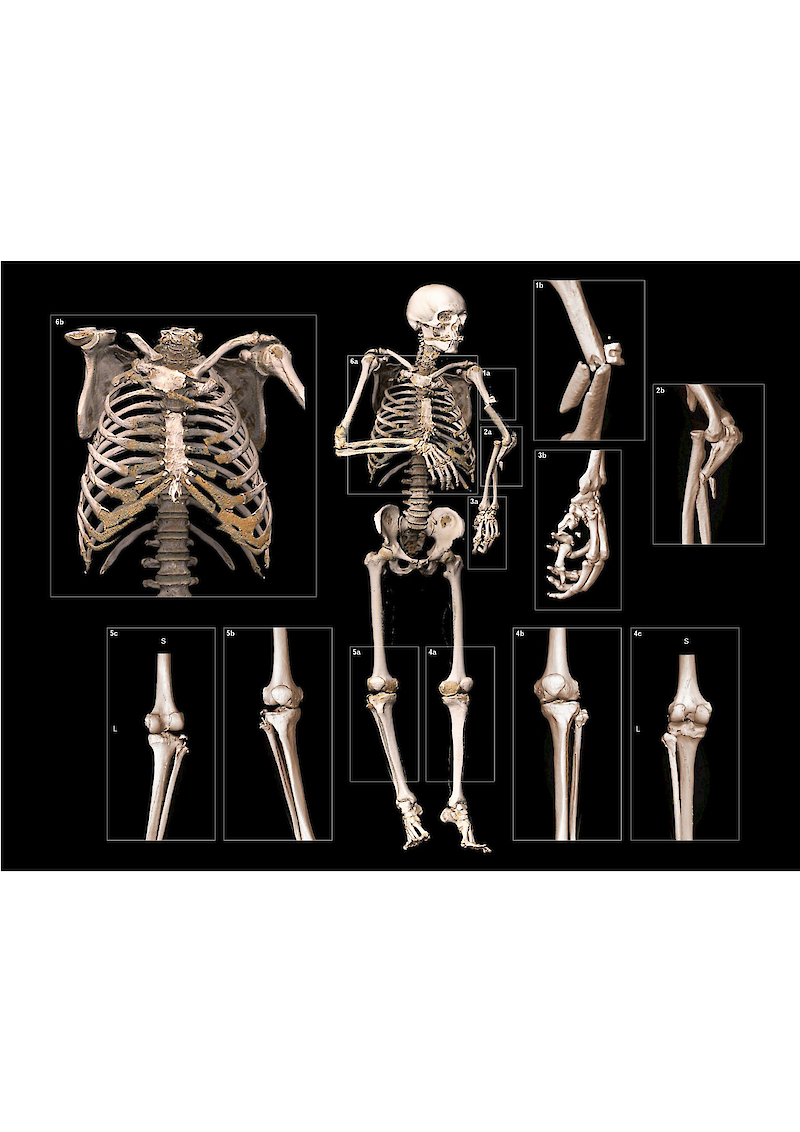 3D-Rekonstruktion des Skeletts als Kontext und der Befunden als Detail mit syngo.via® Darstellung Volumenrendering. Die bei Licht betrachtete menschliche Anatomie bietet nur wenige Farbkontraste. Diese sollen bei einer technisch-visueller Datenrekonstruktion entsprechende Farbkonventionen naturalistisch anmuten angewendet werden, um die Wiedererkennung zu ermöglichen. Mit der Methode des Ausschnitts und der Vergrösserung lassen sich Details bzw. Vergrösserungen besser in ihrem anatomischen Zusammenhang verstehen.