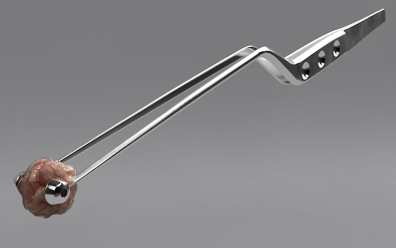 Rendering eines chirurgischen Instrumentes zur Entfernung des Tumors.