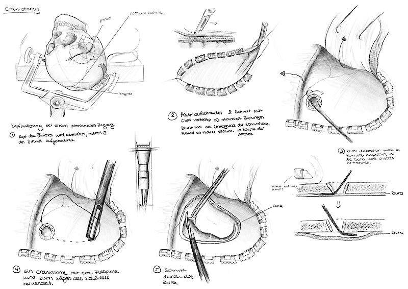 Prozessskizzen zur Craniotomy, gezeichnet in Procreate.