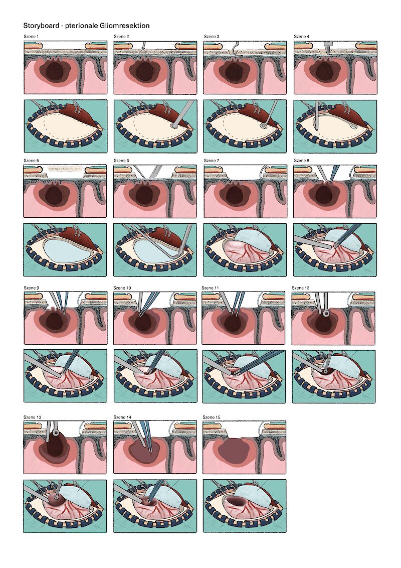 Storyboard des Eingriffes – von der Craniotomy bis zur Entfernung des Tumors.