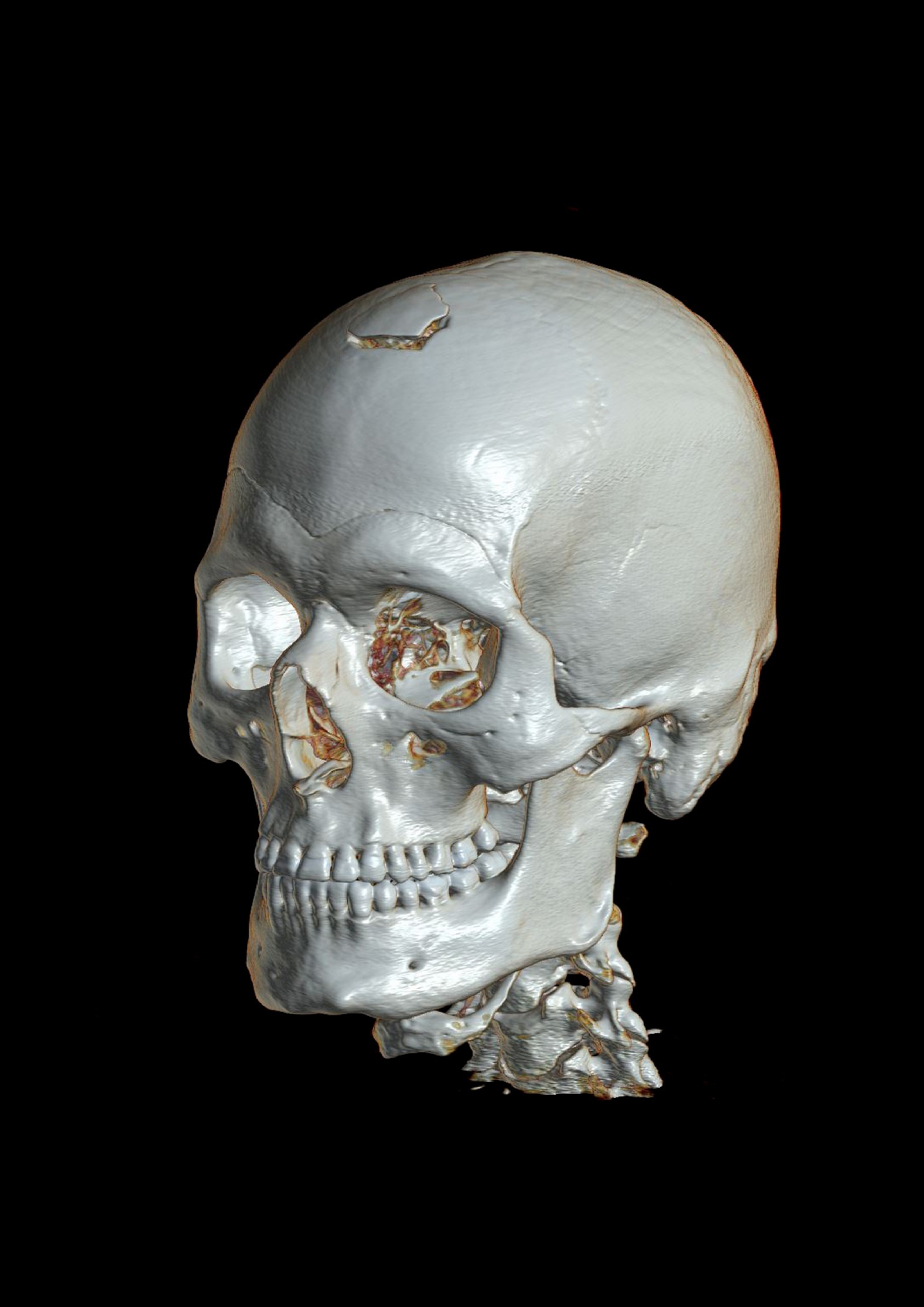 Die Überlagerung und Überschneidung von dreidimensionalen Strukturen vermittelt die räumliche Form oft ungenügend. Das Ergänzen von tiefenwirkenden Schattierungen sowie das Anaglyphenverfahren (Rot-Grün- bzw. Magenta-Cyan-Brille) stellen Möglichkeiten dar, den Eindruck von Räumlichkeit zu vermitteln. 3D-Rekonstruktion des Schädels und Projektils mit syngo.via® (Standard Software-Preset). Darstellung Volumenrendering. Ansicht von links vorne.