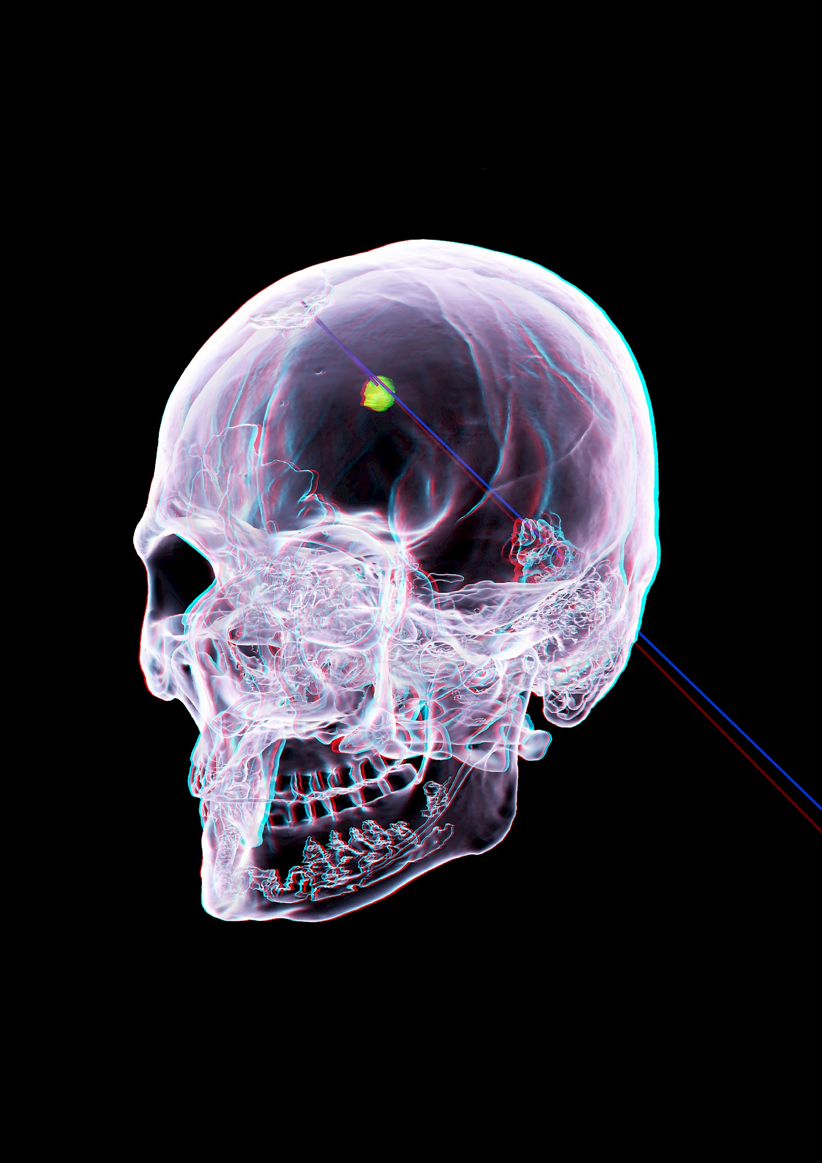 Stereoskopische 3D-Rekonstruktion des Schädels und Projektils mit Projektilkanal. Darstellung mit Cinema 4D. Ansicht von links vorne.