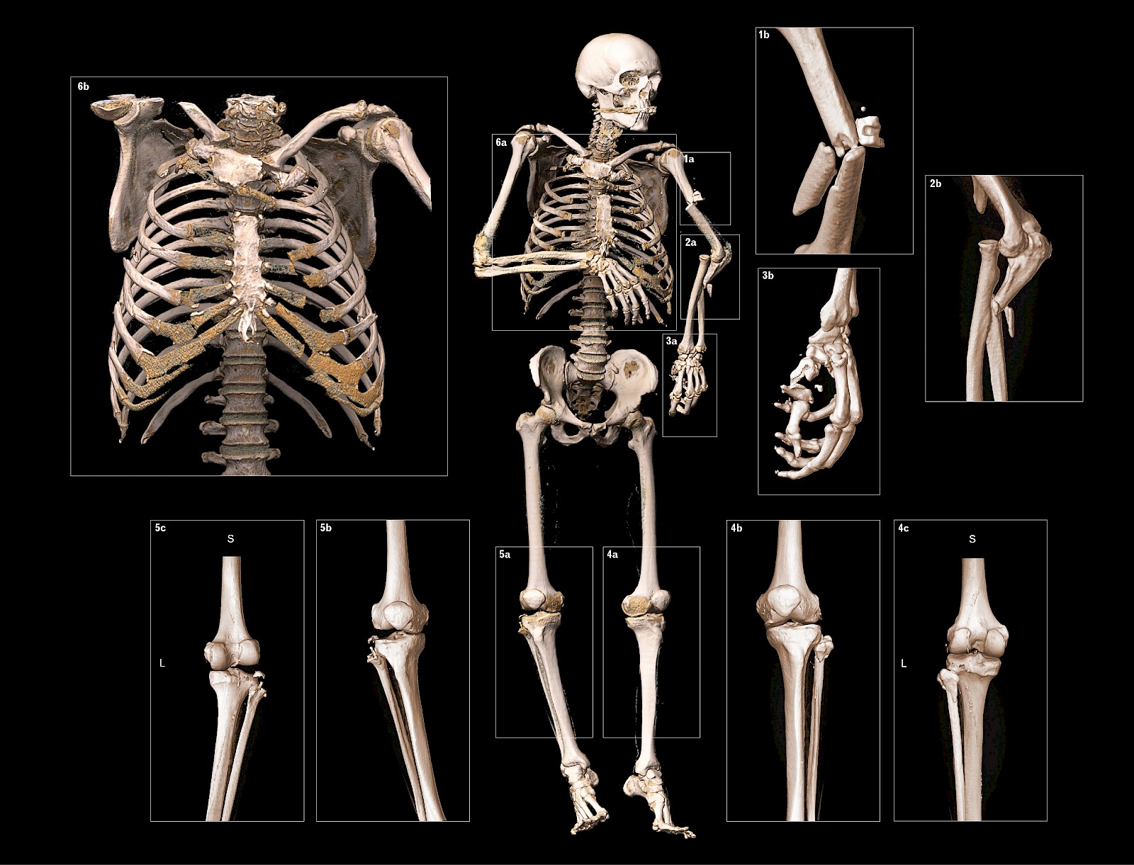 3D-Rekonstruktion des Skeletts als Kontext und der Befunden als Detail mit syngo.via® Darstellung Volumenrendering.   Die bei Licht betrachtete menschliche Anatomie bietet nur wenige Farbkontraste. Diese sollen bei einer technisch-visueller Datenrekonstruktion entsprechende Farbkonventionen naturalistisch anmuten angewendet werden, um die Wiedererkennung zu ermöglichen. Mit der Methode des Ausschnitts und der Vergrösserung lassen sich Details bzw. Vergrösserungen besser in ihrem anatomischen Zusammenhang verstehen.
