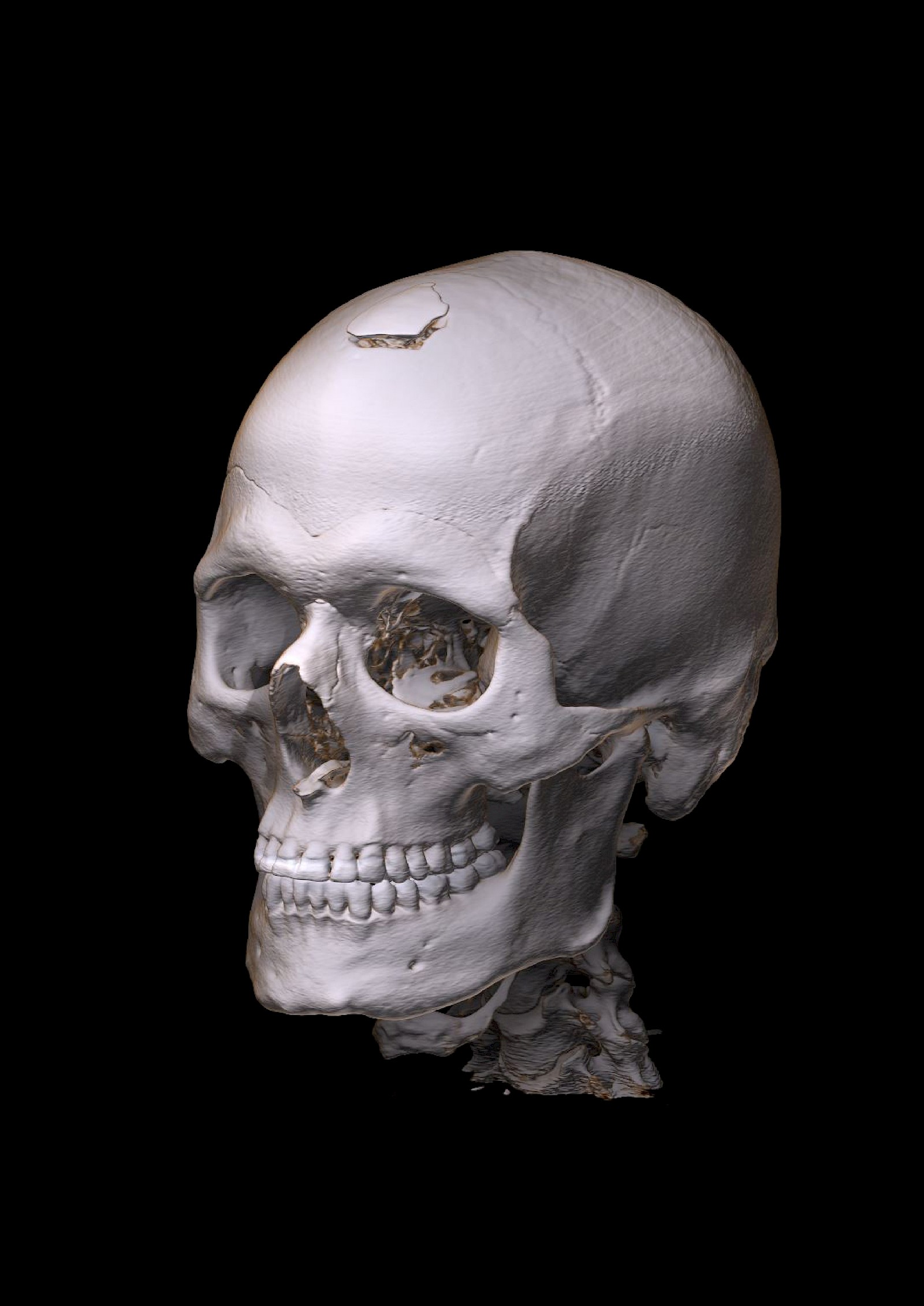 Tiefenvermittlung durch Schattierung der anatomischen Objektform. Darstellung Volumenrendering. Ansicht von links vorne. Im Rahmen dieser Arbeit verbesserte Tiefenvermittlung durch ergänzte räumliche Schattierung.