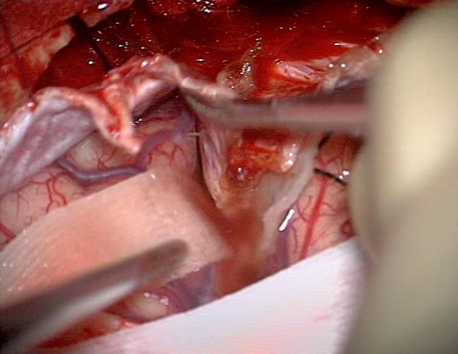 gestaltete MRT- & CT-Daten (Hirnstamm, Arterien), Zoom. l.fekonja_7: Hirn-Operation, Sicht durchs Mikroskop