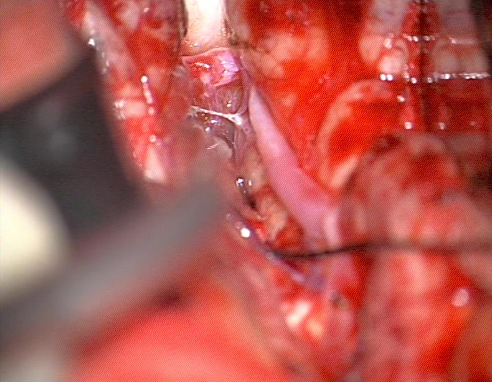 Hirn-Operation, Sicht durchs Mikroskop II