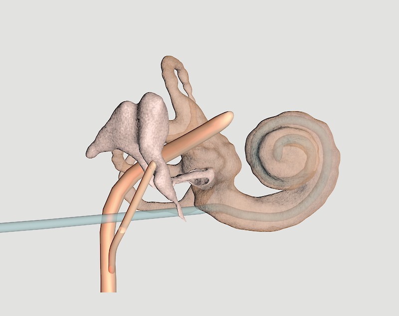 Inner ear structures: Life-like 3D reconstruction of the cochlea, malleus, incus, stapes, and facial nerves from a patient‘s CT scan. Transparency allows us to see the cochlear implant electrode threading into and coiling within the cochlea.