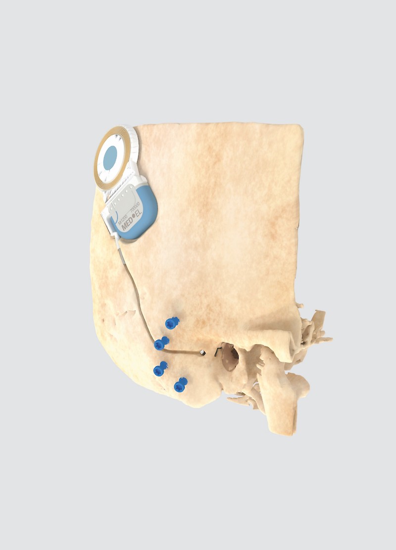 Skull and cochlea transplant: Life-like 3D reconstruction of a patient‘s skull with cochlear implant and blue fiducials (screws). Fiducials allow the robot to capture the movement of the patient‘s head through optical tracking.