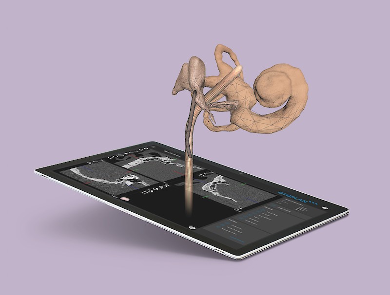 A tablet for surgical planning: Otoplan is a software on a tablet device that allows surgeons to generate 3D ear models from patient CT scans and plan the trajectory of the robot drill. This master‘s project optimizes the visual interface for the surgeon user.
