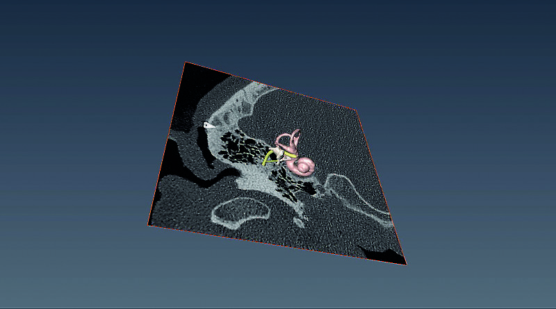 Patient-specific 3D ear and skull models are generated from the pixels of a computed tomography (CT) scan using Amira software.