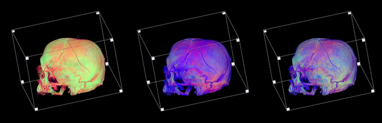 Experimente zur additiven Farbmischung in der VRT: 3D-Rekonstruktionen von farbcodierten Knochengewebestrukturen
