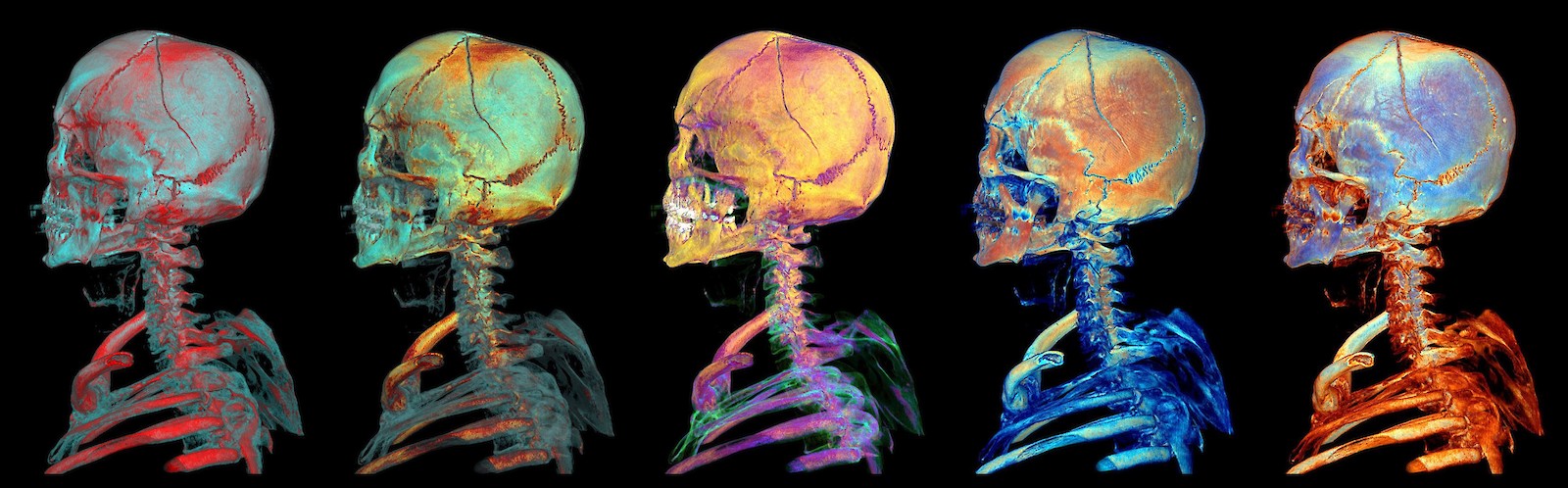 Experimente mit Kalt/Warm-Kontrasten: 3D-Rekonstruktionen des Skeletts von Kopf und Hals der exemplarischen Fallstudie CS01 (anonymisierter Datensatz) mit Haarriss-Schädelfraktur B als Falschfarbendarstellung. Eine kontrastreiche Gestaltung enthält eine Kombination aus mehreren Kontrasten, die sich im Optimalfall ergänzen und in ihrer Wirkung steigern. Es geht dabei nicht nur um Farben in einer Falschfarbendarstellung, sondern auch um das Erzeugen von Kontrasten, um die bei dünnen Frakturlinien besonders subtilen Dichteunterschiede in den CT-Daten effektiv visuell zu vermitteln.