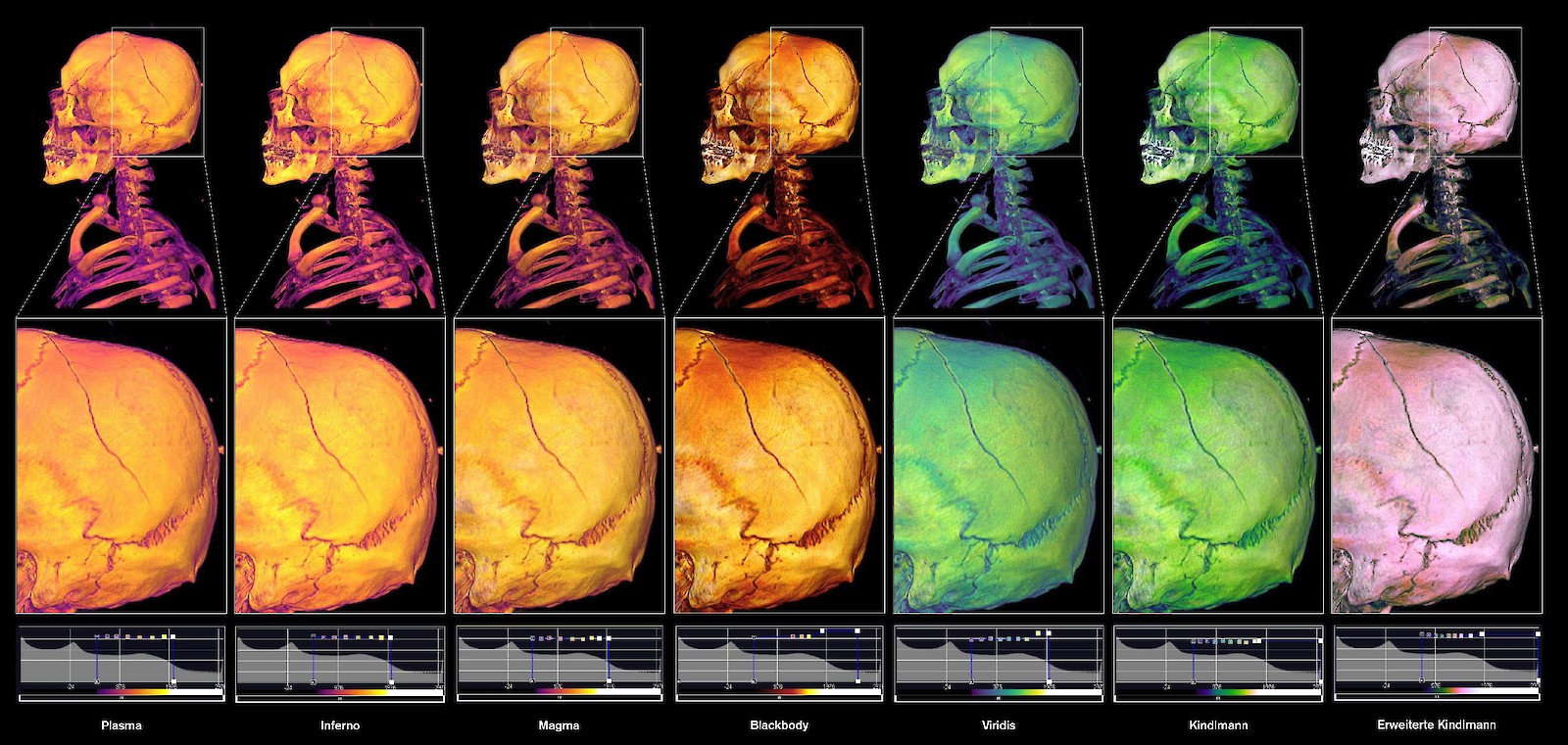 Experimente mit konventionellen Farbskalen (Farbgradienten): 3D-Rekonstruktionen des Skeletts von Kopf und Hals der exemplarischen Fallstudie CS01 (anonymisierter Datensatz) mit Haarriss-Schädelfrakturen A und B als Falschfarbendarstellung. Befund B ist als Ausschnittvergrösserung dargestellt.