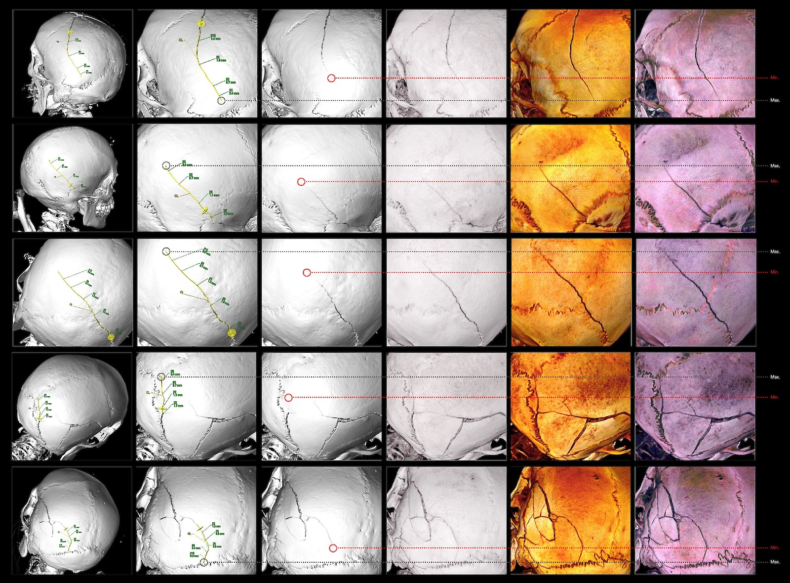 Validierung der optimierten Software-Presets: 3D-Rekonstruktionen des Schädels von fünf repräsentativen Fallstudien mit Haarriss-Schädelfrakturen als Falschfarbendarstellung. Durch die Kontrastverstärkung werden Strukturen in der darzustellenden Datenqualität deutlich visuell erkennbar. Die optimierten Transferfunktionen als gespeicherte Software-Presets ermöglichen bei einer fraktal abnehmenden immer dünner werdenden Frakturspalte (Berstungsfraktur) das unsichtbar Gemessene sichtbar zu machen.