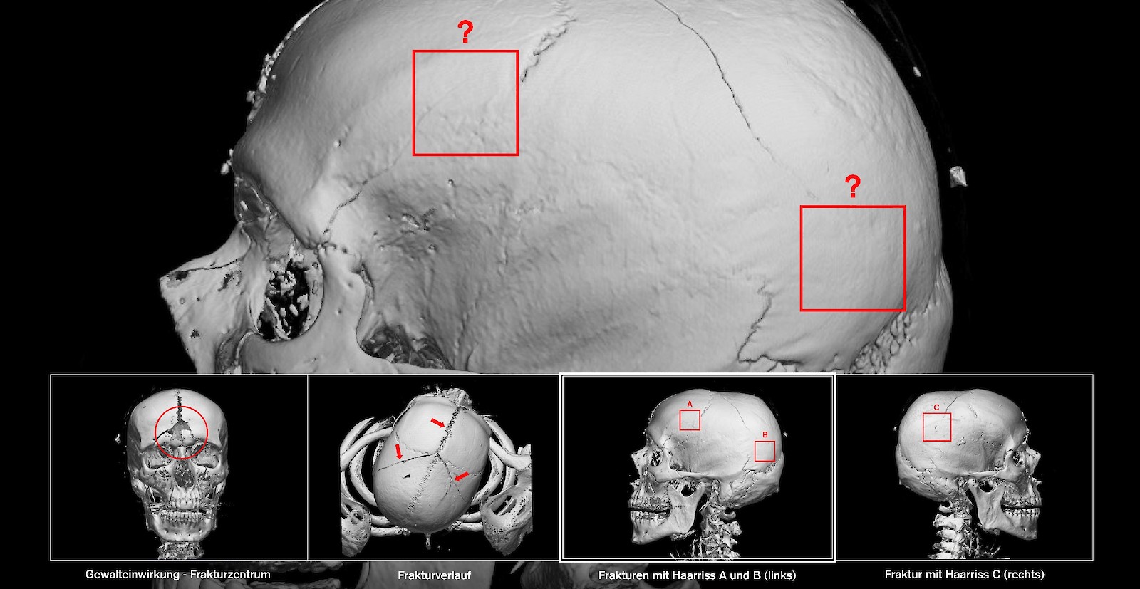 Ausgangslage: 3D-Rekonstruktionen des Skeletts von Kopf und Hals der exemplarischen Fallstudie CS01 mit Haarriss-Schädelfrakturen. In der Rechtsmedizin ist oft das gesamte Ausmass einer Verletzung bis ins allerletzte Detail von rechtlicher Relevanz. Haarrisse sind besonders dünne Risse in Schädelknochen, die bei Verwendung standardisierter Software-Presets vom Hersteller zur dreidimensionalen Rekonstruktion oft ungenügend oder gar nicht dargestellt werden.