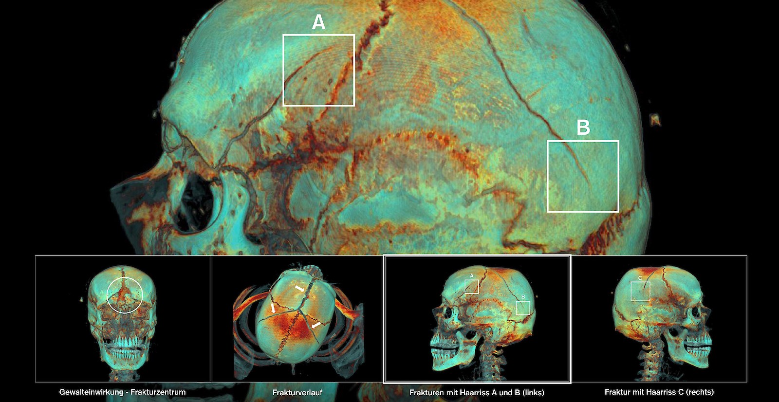 Ergebnisbeispiel: Anwendung eines Software-Presets als Kalt/Warm-Kontrast. Eine kontrastreiche Gestaltung ist eine Kombination aus mehreren Kontrasten, die sich im Optimalfall ergänzen und in ihrer Wirkung steigern. Es geht dabei nicht nur um Farben in einer Falschfarbendarstellung, sondern auch um das Erzeugen von Kontrasten, um die effektive visuelle Vermittlung der hier erkenntnisvermittelnden, bei dünnen Bruchlinien besonders subtilen Dichteunterschiede in den CT-Daten.
