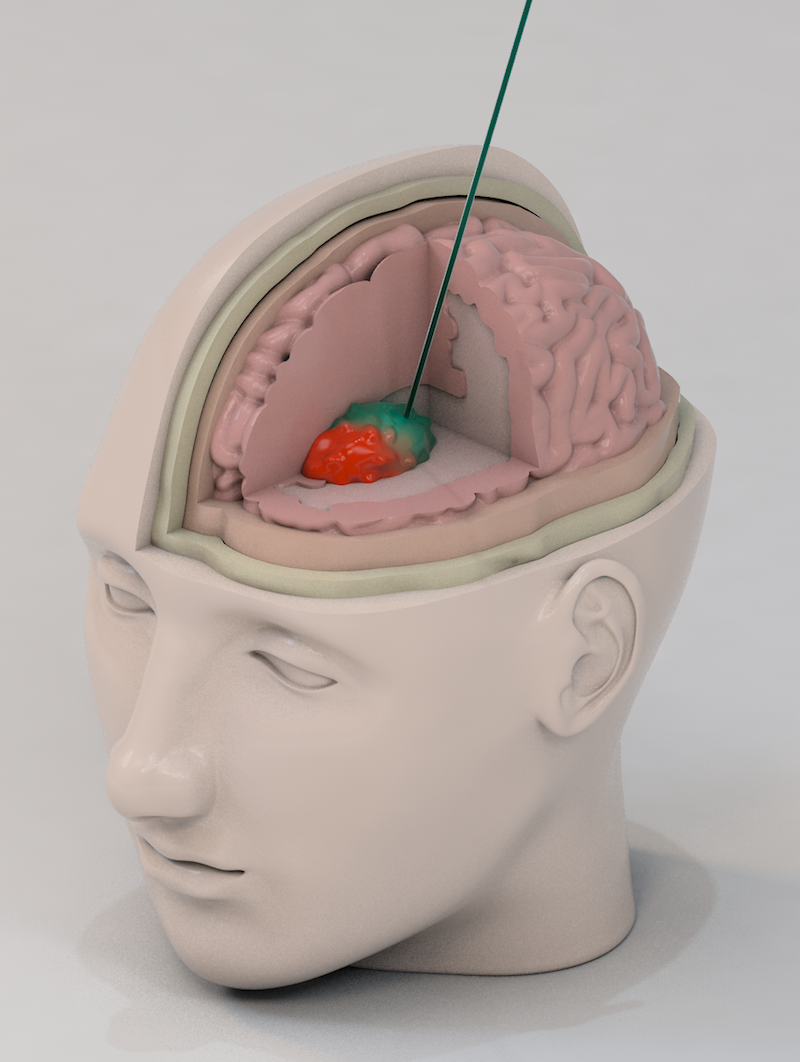 Alen Guberinic: «In der Visualisierung ist ein Kopf dargestellt, an welchem aufgezeigt wird, wo sich der Tumor lokalisieren lässt und wie die Kanüle zum Tumor verläuft. Angestrebt wurde ein modellhaftes Aussehen, welche an die Materialität von Kunststoff oder gar Elfenbein erinnert.»