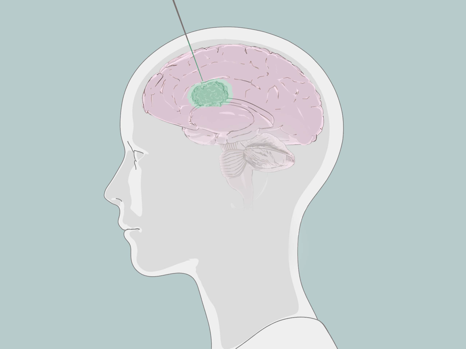 Anna-Lea Krieg: «Die Gestaltung zielt auf Sachlichkeit ab, um das Verfahren möglichst seriös vermitteln zu können. Dafür werden ein «zeichnerisches» Aussehen und gedämpfte Töne eingesetzt, abgeleitet von den InCephalo-Farben.»