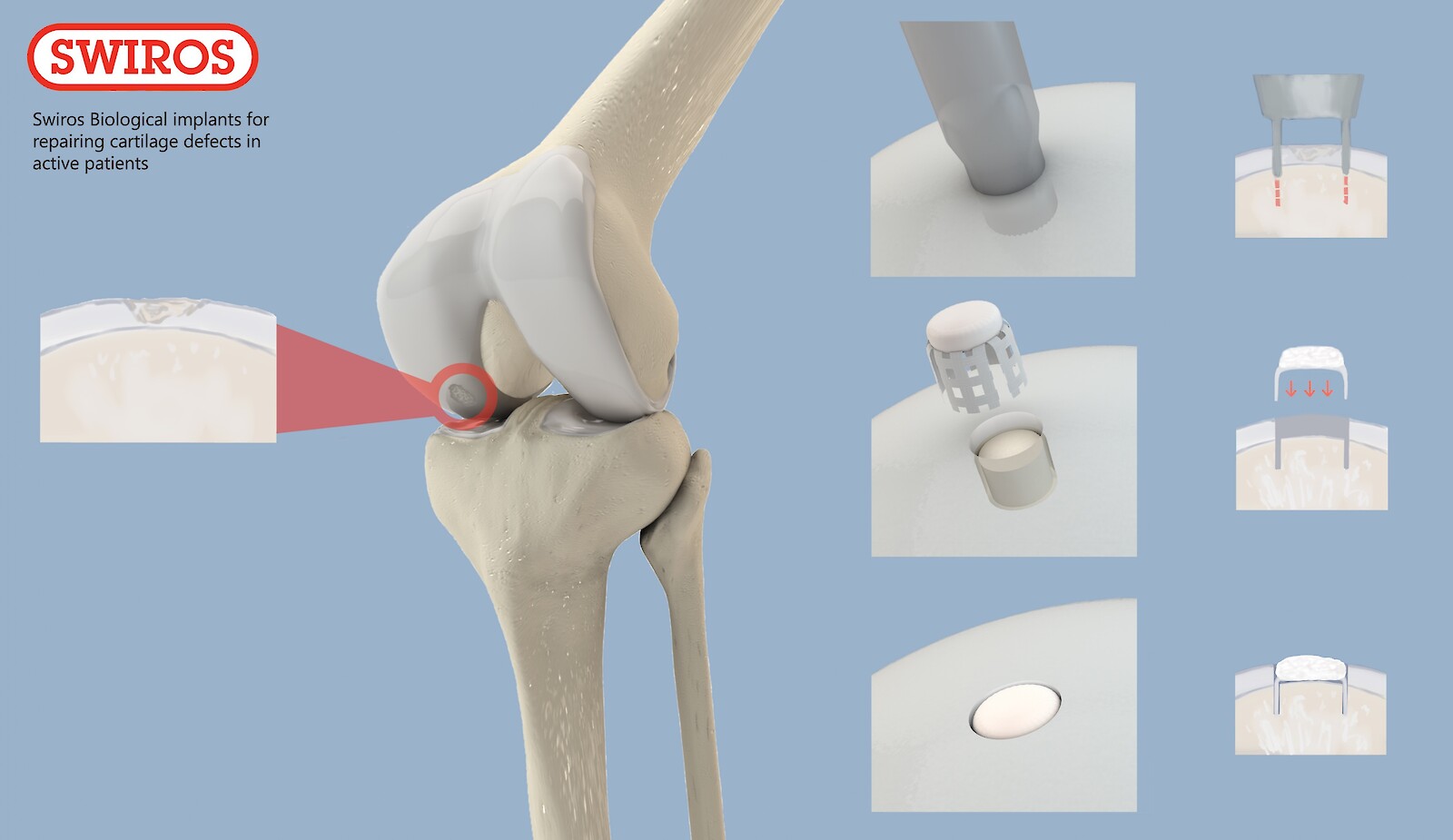 Nadine Schreiber: «Ein detailliertes Kniemodell soll zeigen, wo ein potenzieller Knorpeldefekt vorkommen kann. Die drei wichtigsten Schritte des Einsatzprozesses werden durch eine Kombination von Chirurgenansicht und seitlichem Querschnitt einfach verständlich gemacht.»