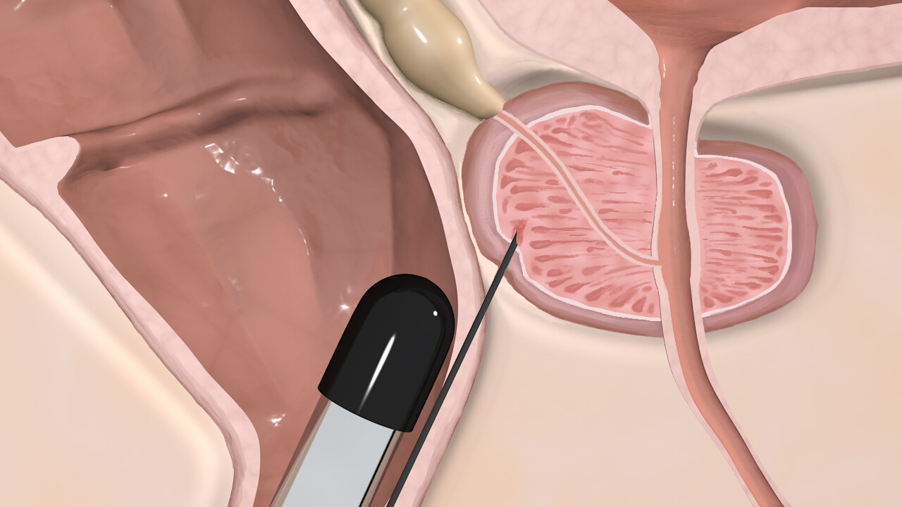 Sofia Poku: «In meiner Visualisierung geht es um den Einstich der Prostatabiopsie und die Folgen, die nach einer Biopsie entstehen können.»