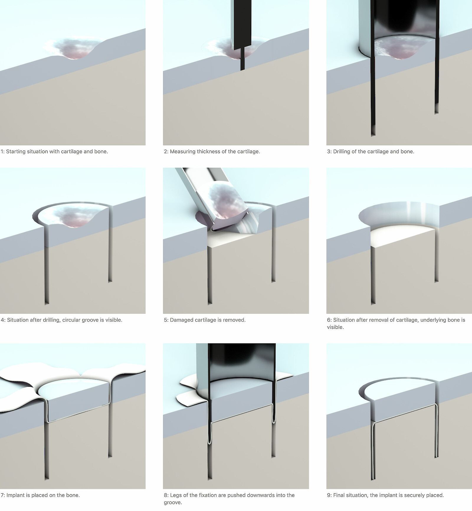 Michelle Weber, Prozessübersicht SWIROS: «In nine images I have visualized the surgery reduced to its key moments. To best show what is happening inside the cartilage and bone during the surgery, I decided on a sectional view.»