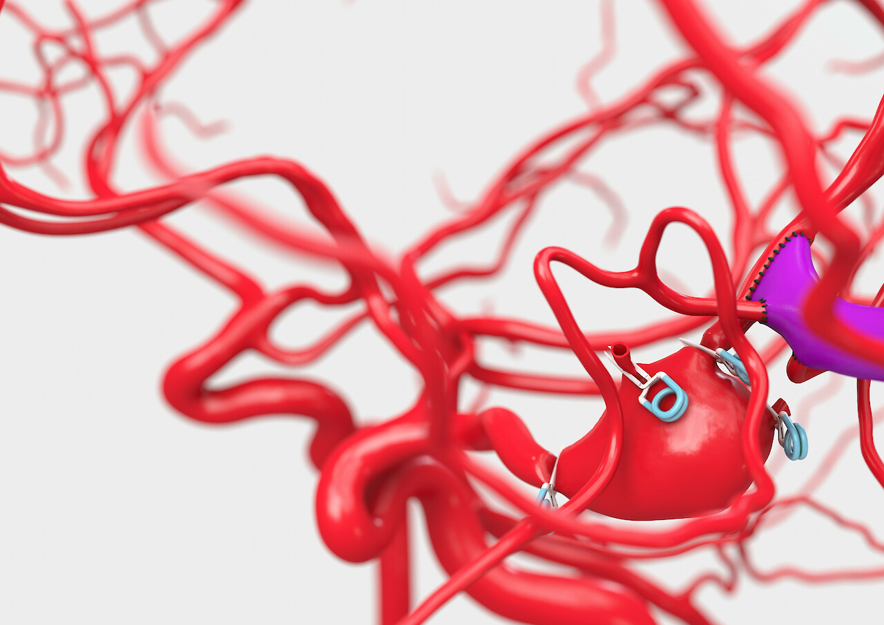 Das Bild zeigt eine operative Situation an einem Hirn-Aneurysma.