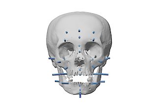 Das Setzen von sogenannten «Tissue Depth Markers» ist ein essenzieller Teil des Rekonstruierens. Diese zeigen an, wie viel Gewebe im Durchschnitt für spezifische Nationalitäten, Geschlechter und Alter auf dem Knochen liegen.