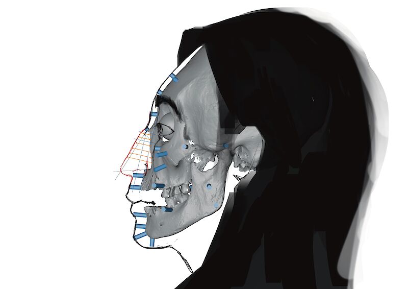 Die Lebendiskaya Methode zur Annäherung der Nasenform. Eine von vielen Methoden, um die Nase zu rekonstruieren, dabei orientiert man sich an der Form der Nasenhöhle im Profil.