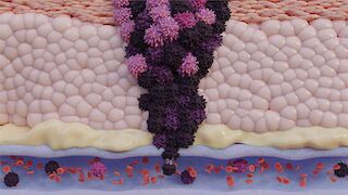 A zoom-in view of a melanoma (skin cancer) tumor entering a vein in a section of skin. This process is referred to as metastasis, where cancer cells spread throughout the body via blood vessels.