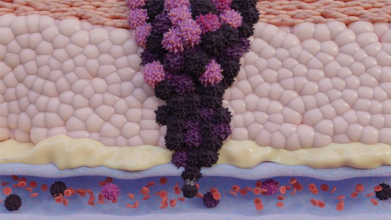 A zoom-in view of a melanoma (skin cancer) tumor entering a vein in a section of skin. This process is referred to as metastasis, where cancer cells spread throughout the body via blood vessels.
