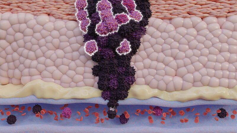 A zoom-in view of a melanoma (skin cancer) tumor entering a vein in a section of skin. This process is referred to as metastasis, where cancer cells spread throughout the body via blood vessels.